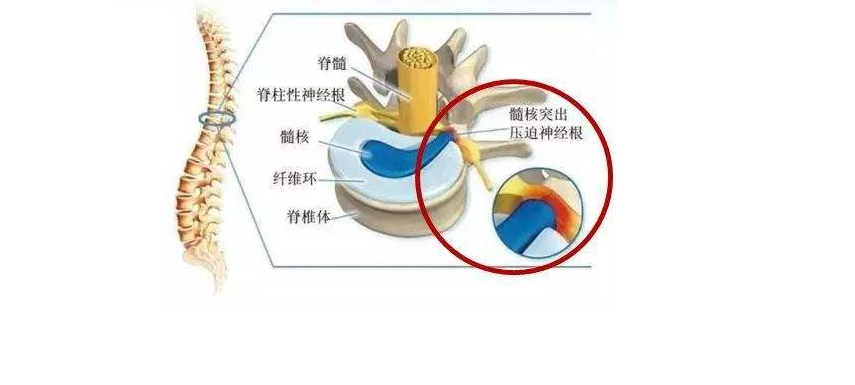 女30岁腰椎间盘突出,我30岁腰椎间盘突出怎么办