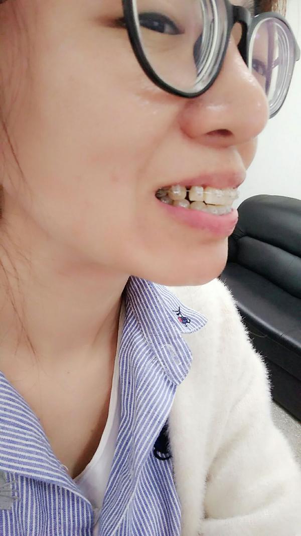 34岁大龄女二次牙齿矫正的经历