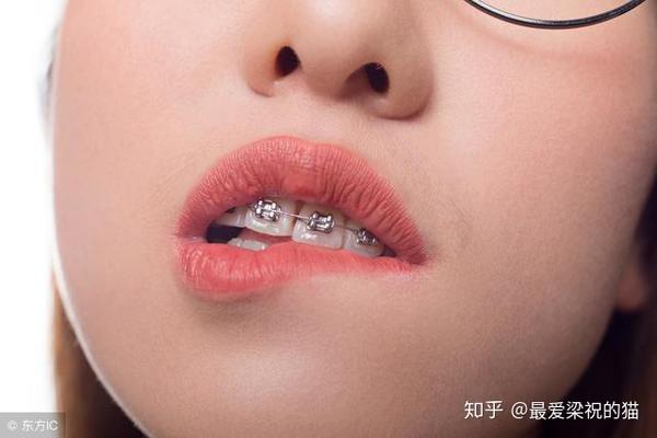 大龅牙做牙齿矫正是传统矫正好还是隐形矫正好?