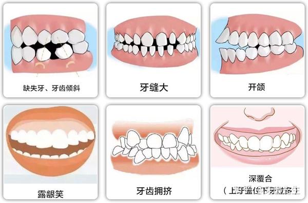 各种各样的牙齿不整齐,常常会带来很多坏结果.