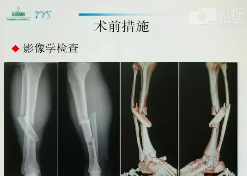 郑龙坡教授:复杂胫腓骨多段骨折的治疗经验