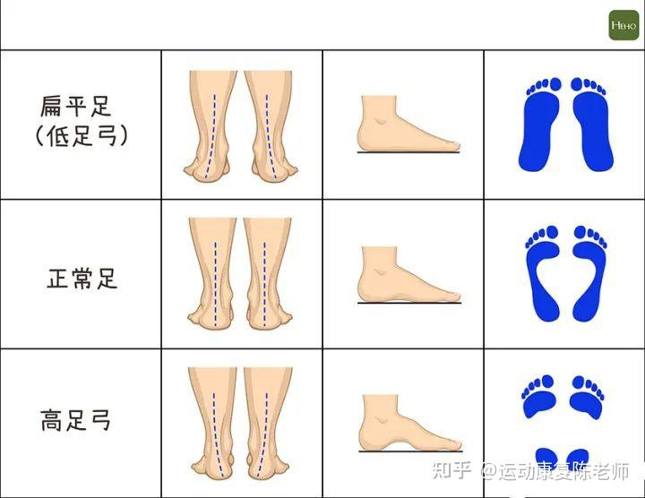 脚后跟位置不正膝盖疼痛竟然和脚跟有关