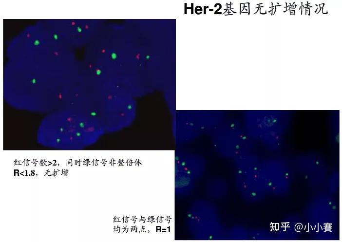 乳腺癌her2基因扩增检测(绿色:染色体着丝粒,红色:her2)circrna荧光