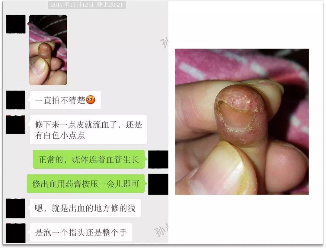 你不得不看的甲疣30经典案例