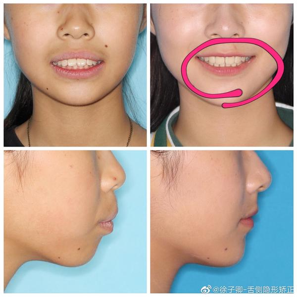 后来翻了徐子卿微博发现治疗结束的患者普遍存在:上面两下大门牙中线