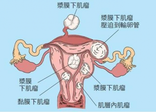 图片来源于网络 > >>> 黏膜下子宫肌瘤 子宫肌壁间肌瘤向宫腔内生长