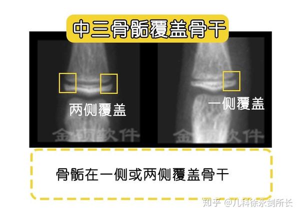 现代版图谱法简单快速推测孩子生长发育阶段