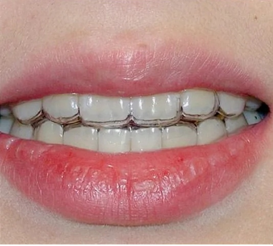 隐形牙套像"塑料"一般?真的可以像钢牙矫正一样好吗?