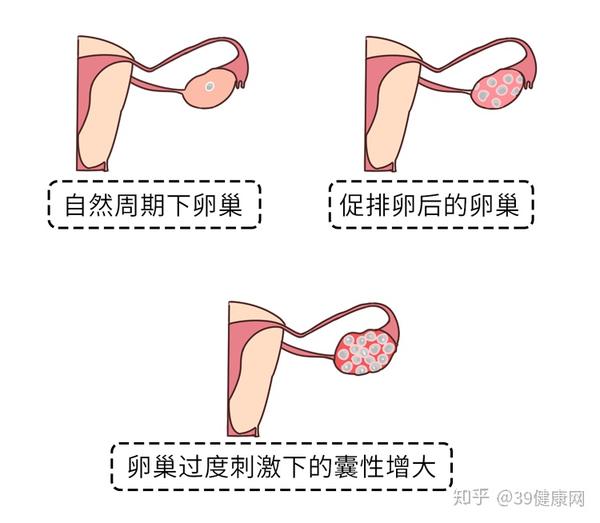 促排卵过程还有概率发生 卵巢扭转 进而导致卵巢缺血坏死 如果发现不