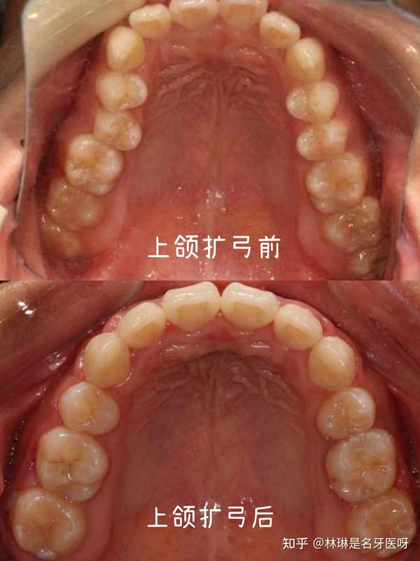 牙齿上颌扩弓前后对比
