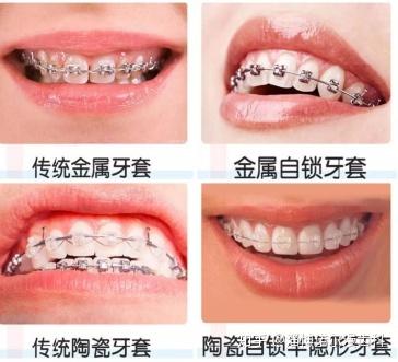 今天全面分析一下各种类牙套的优缺点及收费价格,告诉大家