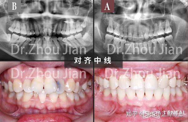 3年"蜕变"| 重度拥挤 大量坏牙,高难度矫正案例