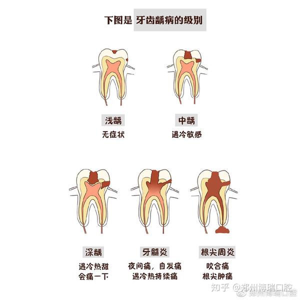 蛀牙是因为牙里有虫吗?