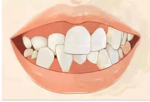 孩子牙齿畸形几岁矫正