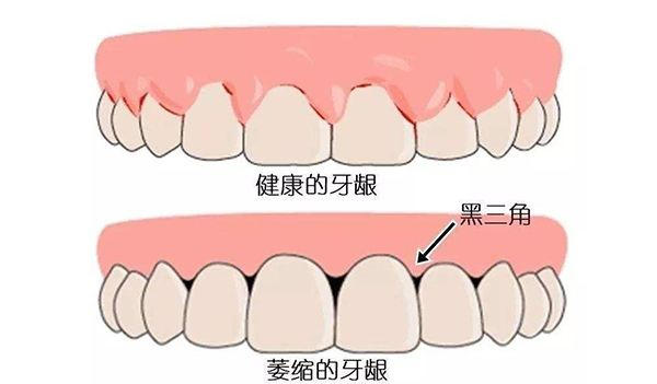 智造微笑,分享美好 1 人 赞同了该文章 一,牙齿的"黑三角"是什么呢?