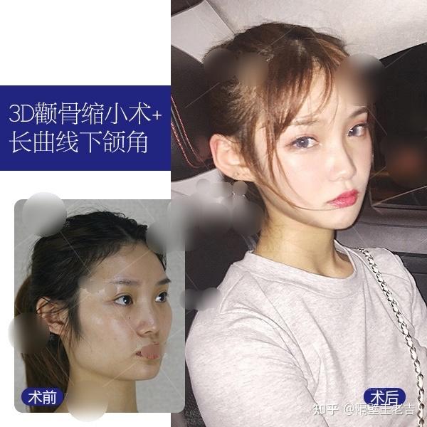 成都削骨下颌角哪个医生好张立天李继华李运峰怎么选