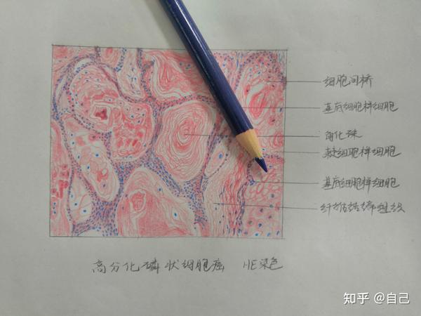 高分化鳞状细胞癌红蓝铅笔