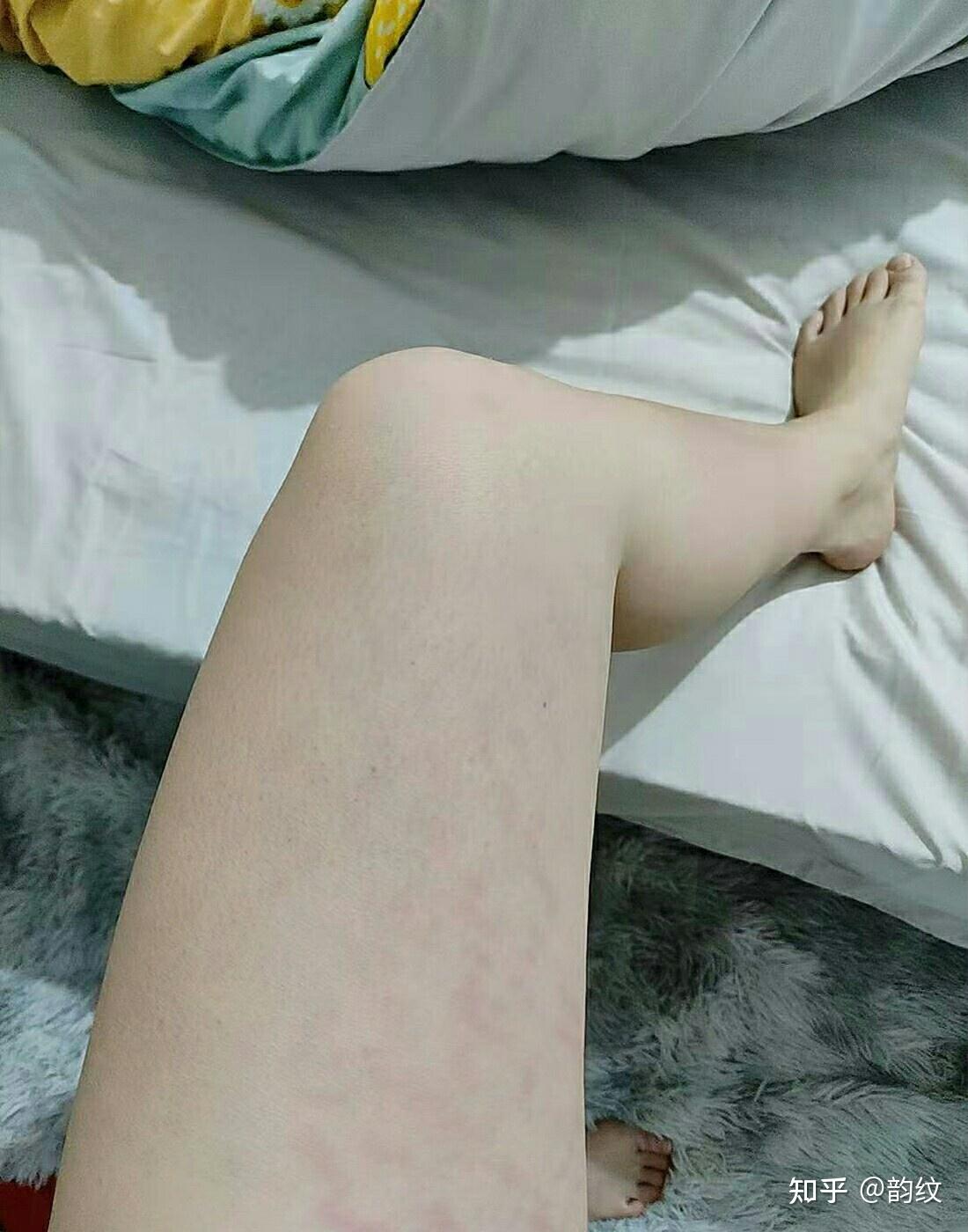 生长纹肥胖纹究竟是怎回事