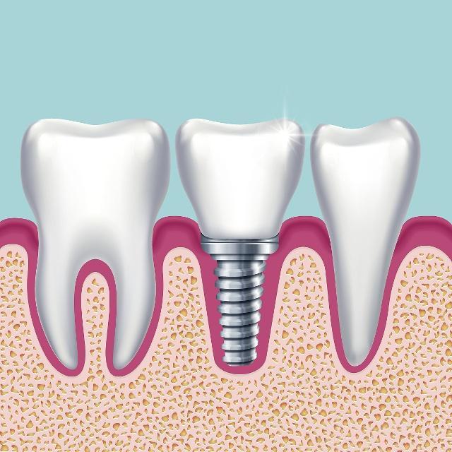 7个步骤带你了解种植牙全过程