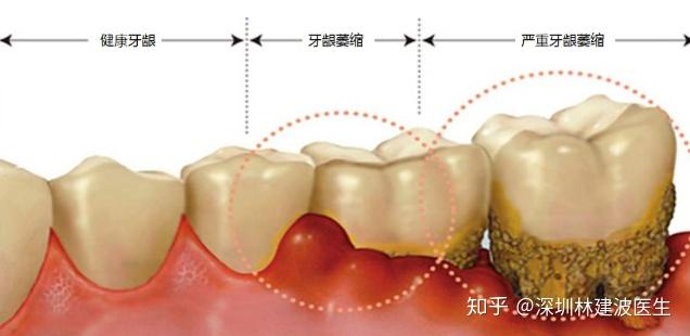 牙龈萎缩分类