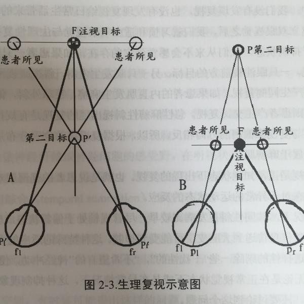 双眼视差大,看东西时会产生双像,这正常吗?