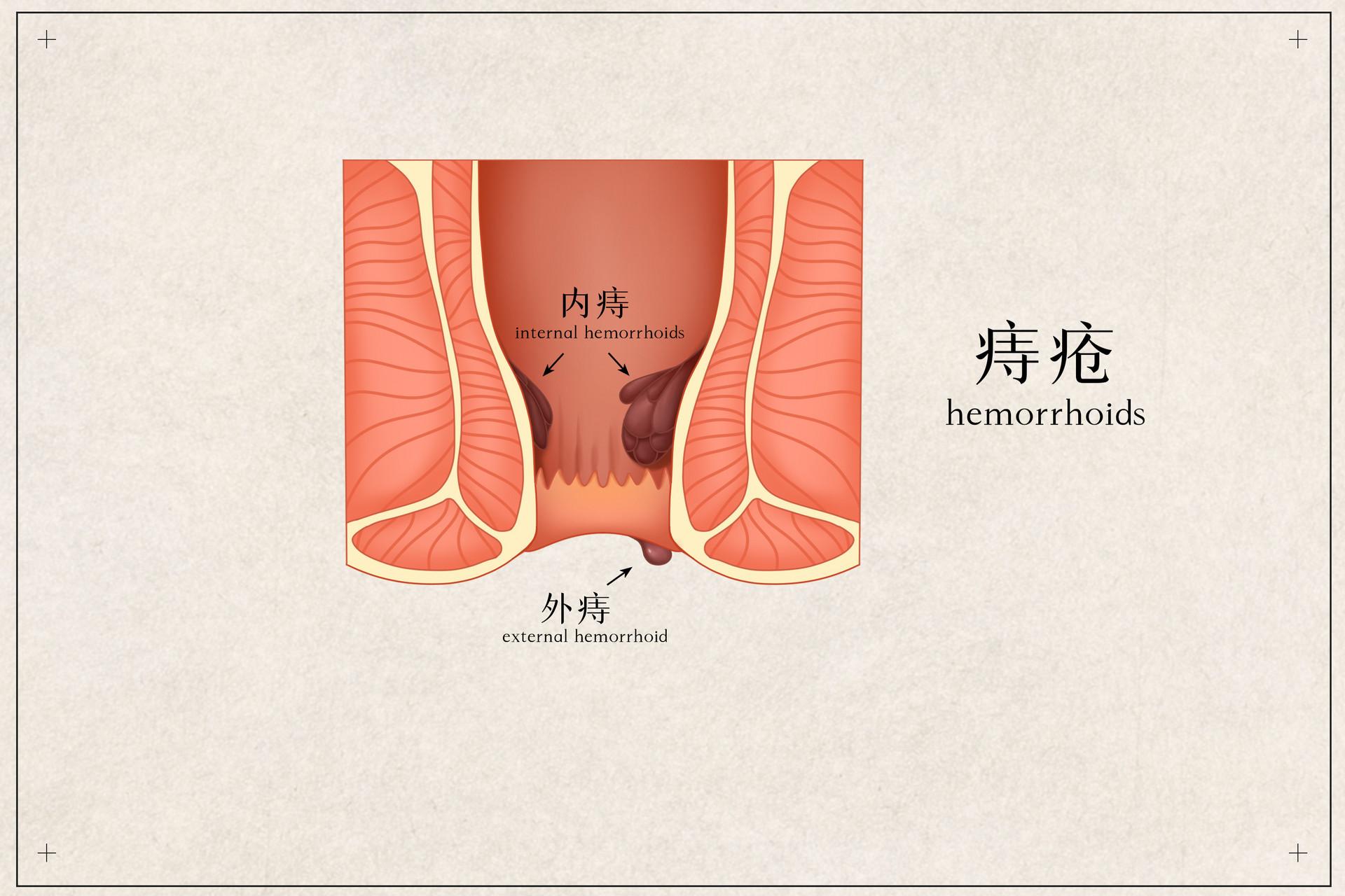 得了痔疮后等它自愈还是用药物治疗呢?注意这几点,治疗效果更好