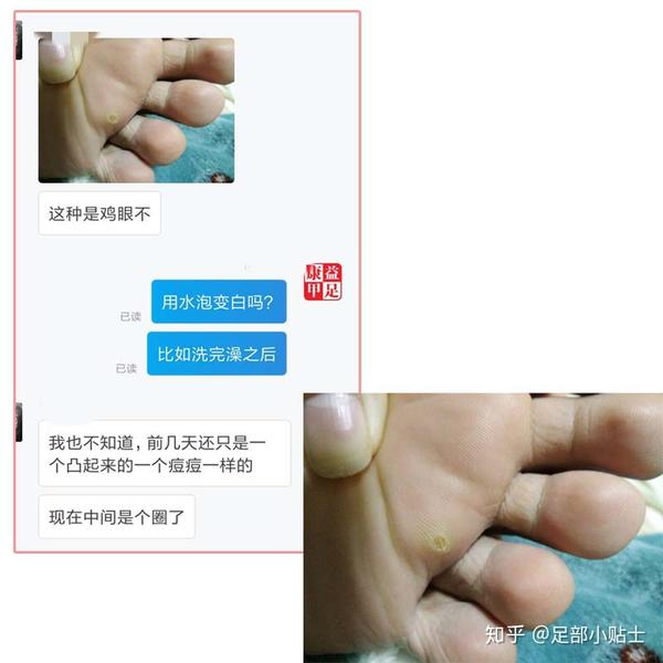 宝妈们注意了孩子脚上这些不是鸡眼不要盲目用鸡眼贴