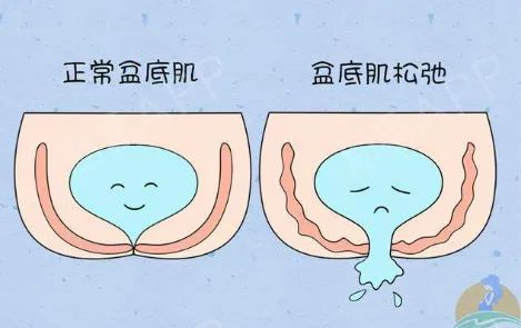 盆底肌松弛示意图,图片源自网络