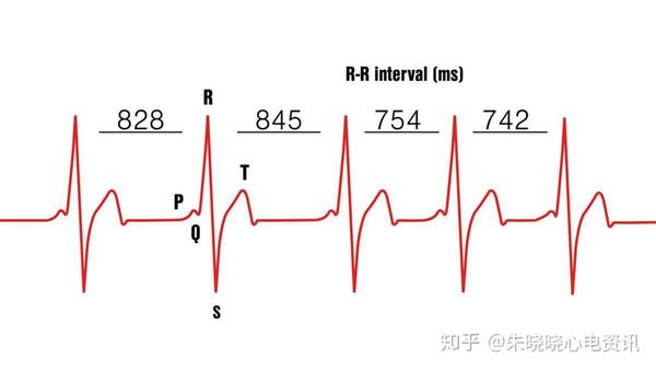 及预防,可能是预测心脏性猝死和心律失常性事件的一个有价值的指标