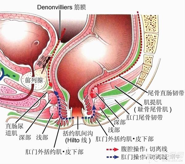 直肠癌全直肠系膜切除术中盆腔植物神经的易损区域及