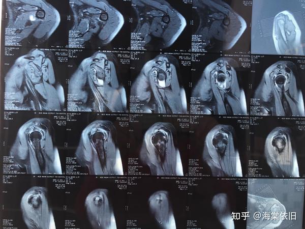 磁共振片子看看骨膜损伤严重吗疼了两个月了晚上休息不好疼醒还几次