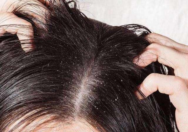 头皮油腻发痒,头屑掉发增多!换季头发问题增多,就该这么办!