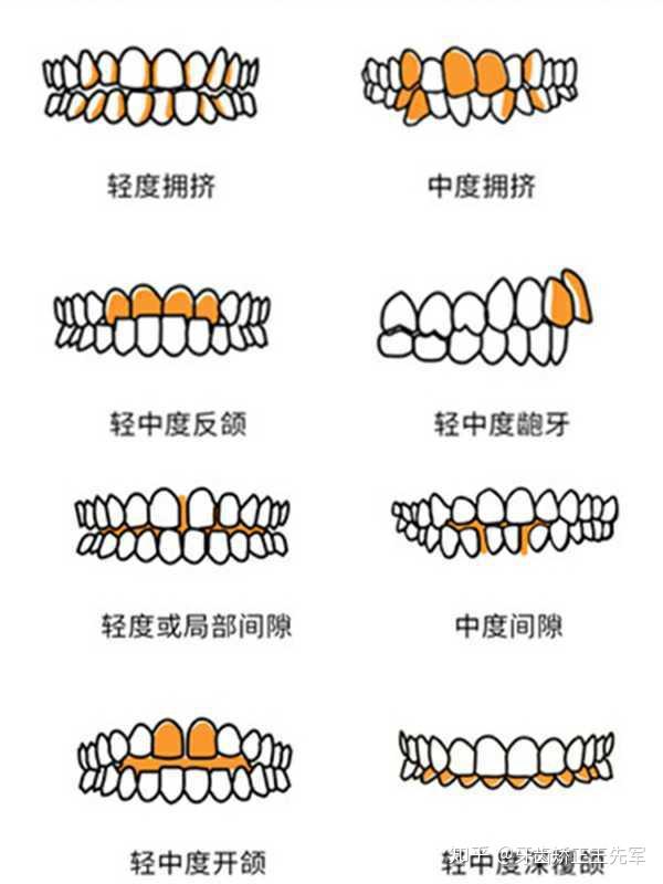 哪些牙齿畸形要做矫正牙齿矫正有什么好处