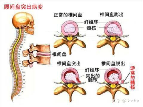 椎间盘膨出硬膜囊受压可怕吗?