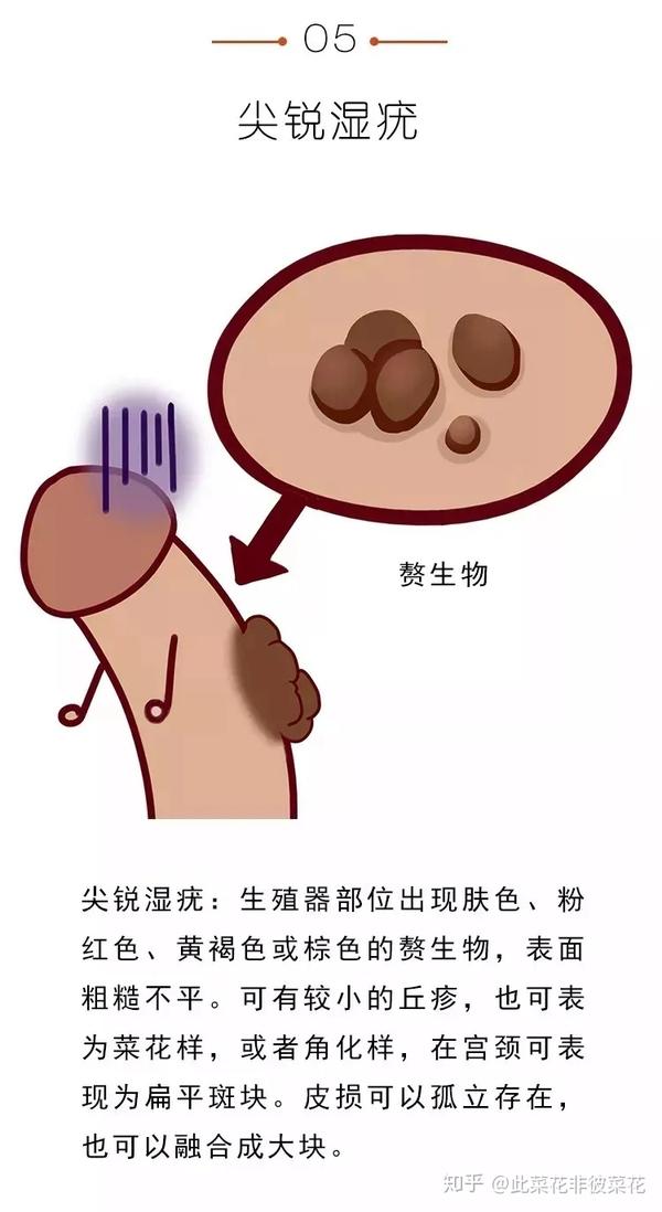 图解湿疣疱疹梅毒性病到底长啥样