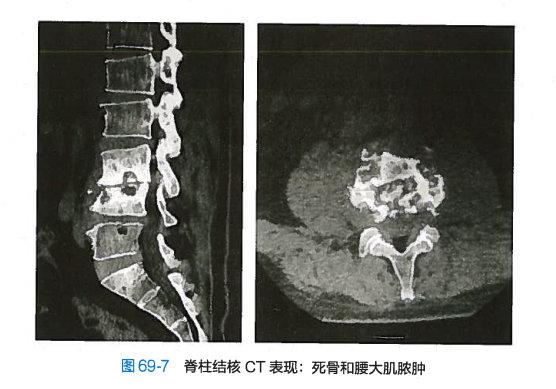 单纯性滑膜结核或单纯性骨结核→全关节结核→窦道或瘘管→继发感染