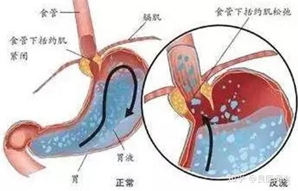 浅析中医治疗反流性食管炎的优势