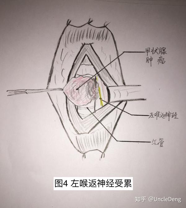 术中见左侧喉返神经受累