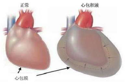 李中伟 少量的心包积液严重吗?该如何治疗?