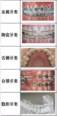 自锁和普通牙套的样子_传统牙套和自锁牙套_自锁牙套比普通牙套大