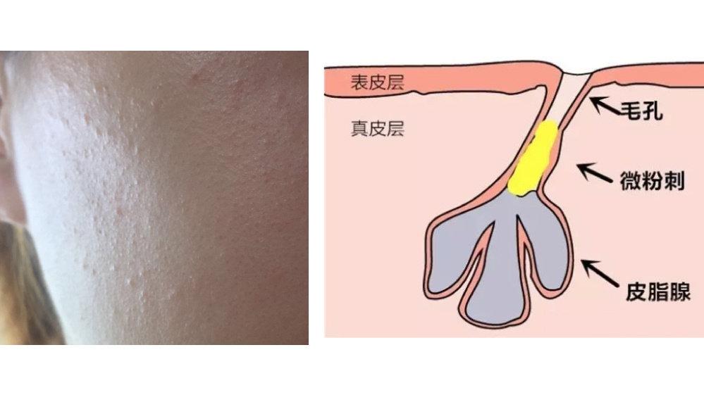 屏障受损肌 你有没有觉得:屏障受损后皮肤很难抵御刺激;皮肤保湿能力