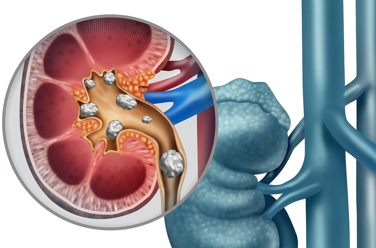 从肾结石排出的有趣经历到人性的感悟