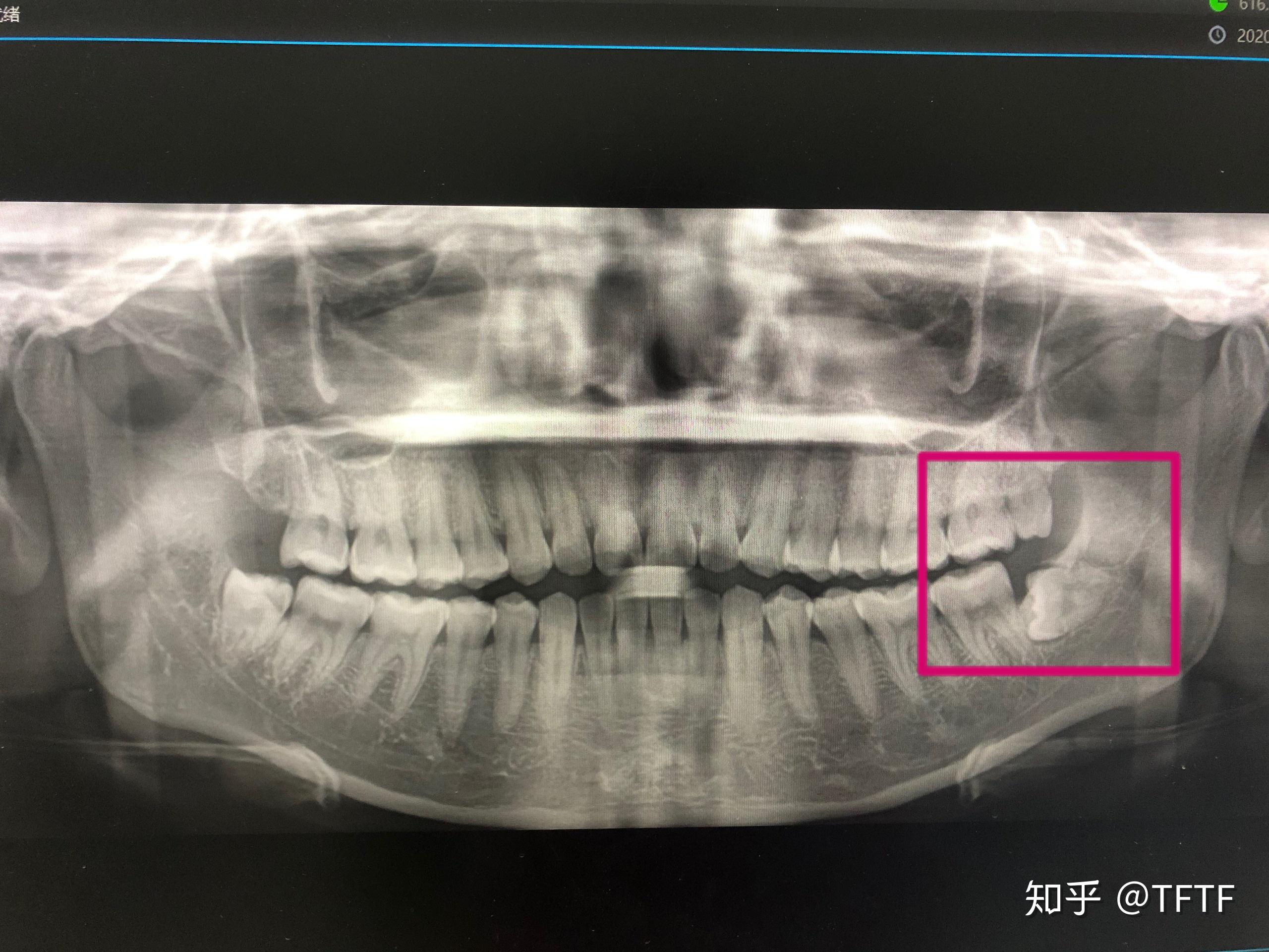 横着长的阻生齿智齿拔掉前面的牙齿需要植骨吗