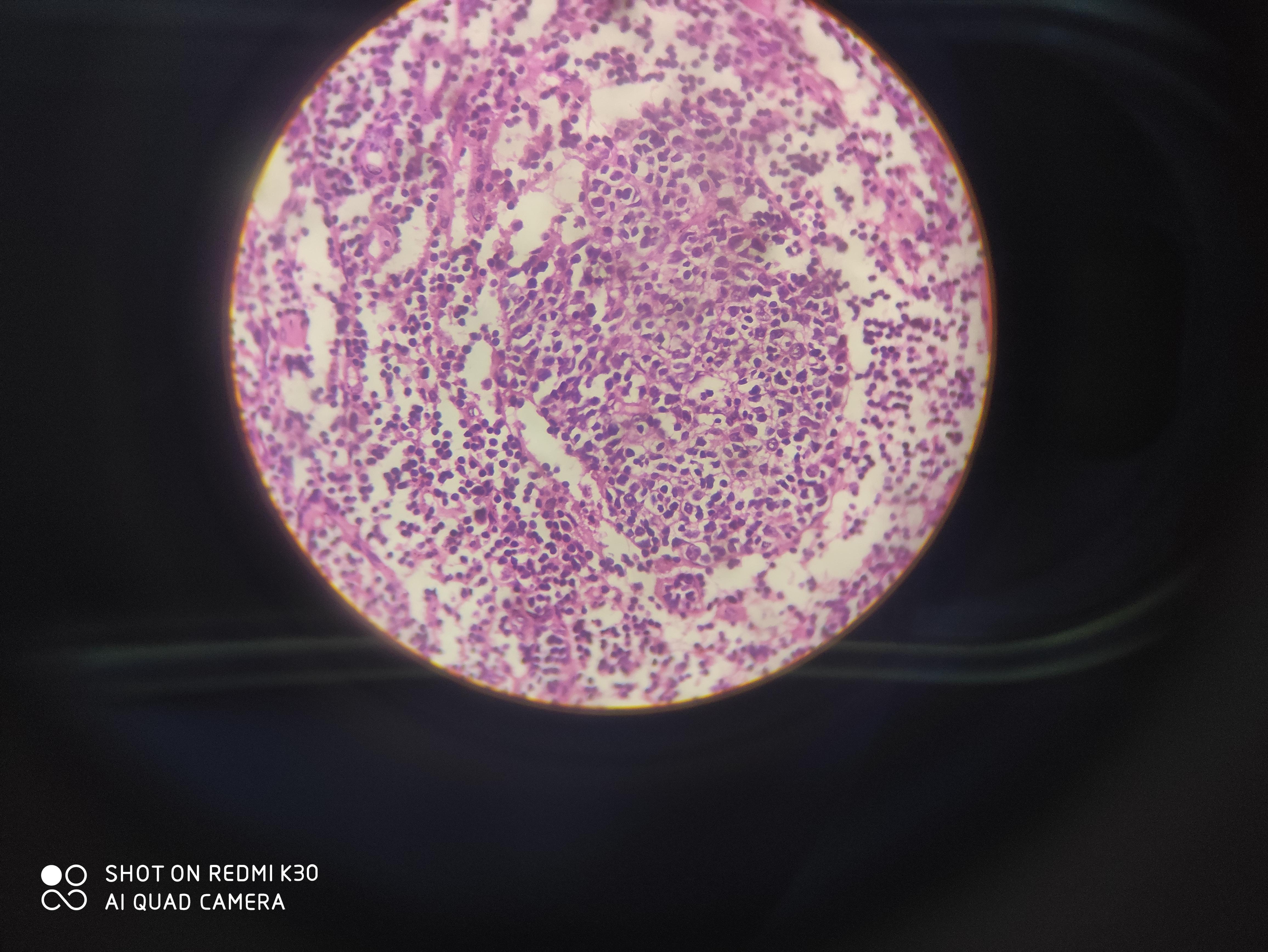 类上皮细胞也不是空泡状的蜂窝织炎性阑尾炎注意胞浆与胞核的形状与