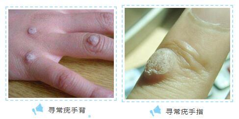 寻常疣是一种病毒感染性皮肤病,是一种皮肤表面赘生物,多由hpv-1感染