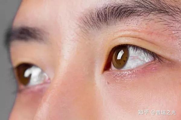 眼睛看东西模糊,容易流泪,是怎么了?