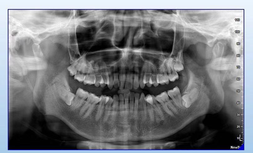 低位横生埋伏阻生齿拔除的非专业分享
