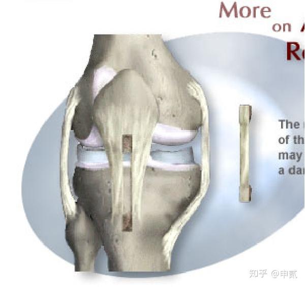 对于自体骨-髌腱-骨移植,可能会发生供体髌骨髌腱部位病变,应注意股四
