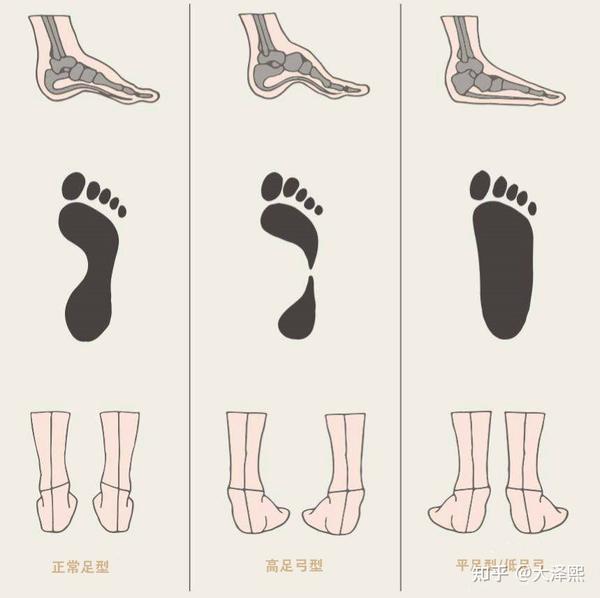 3. 根据跑步时的内旋状况,判断自己属于正常足,内翻足还是外翻足.