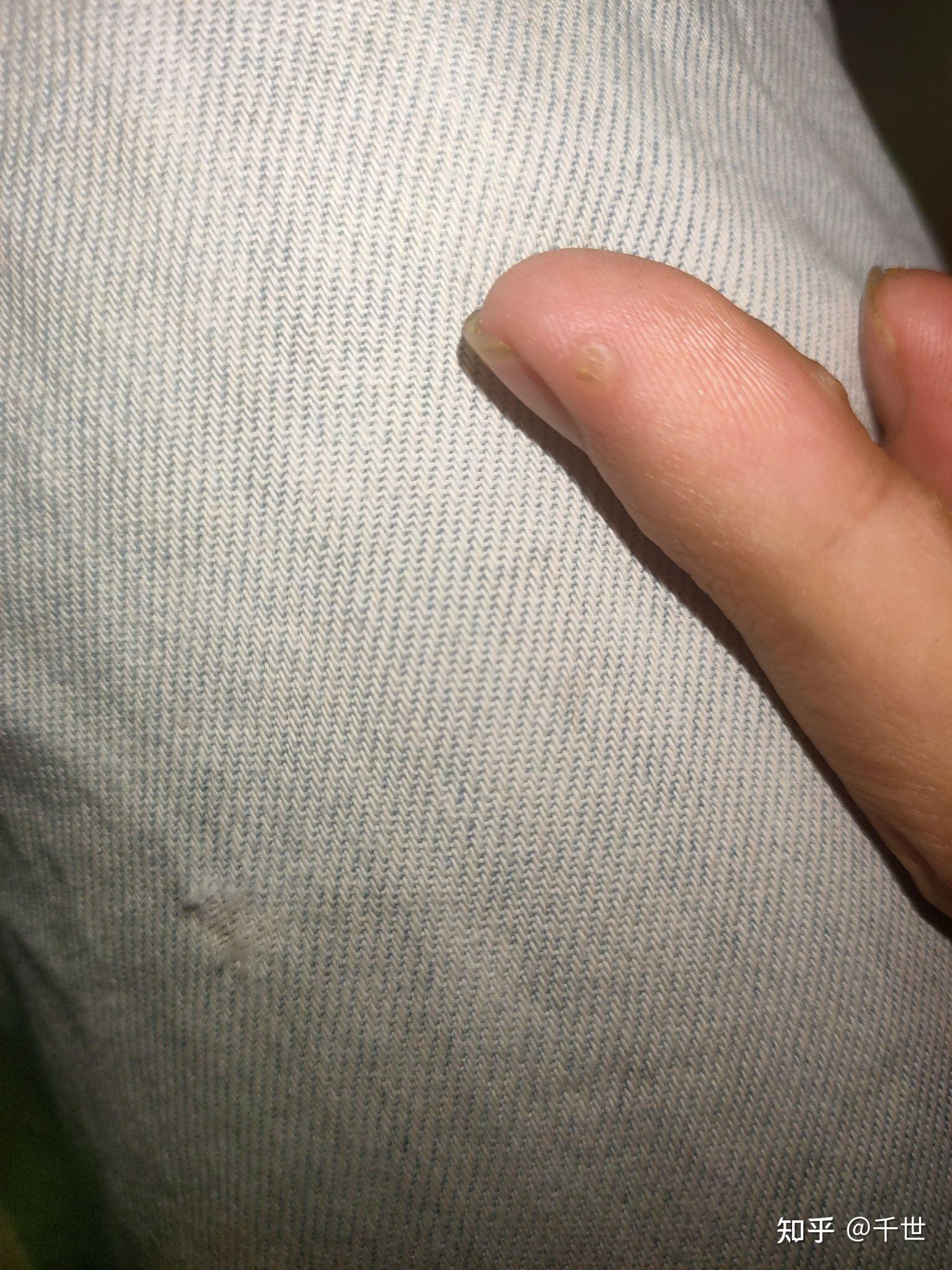 小拇指是肉刺其它的是跖疣这是没用药前